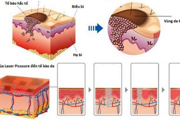 Trị nám một lần duy nhất bằng công nghệ Picosure